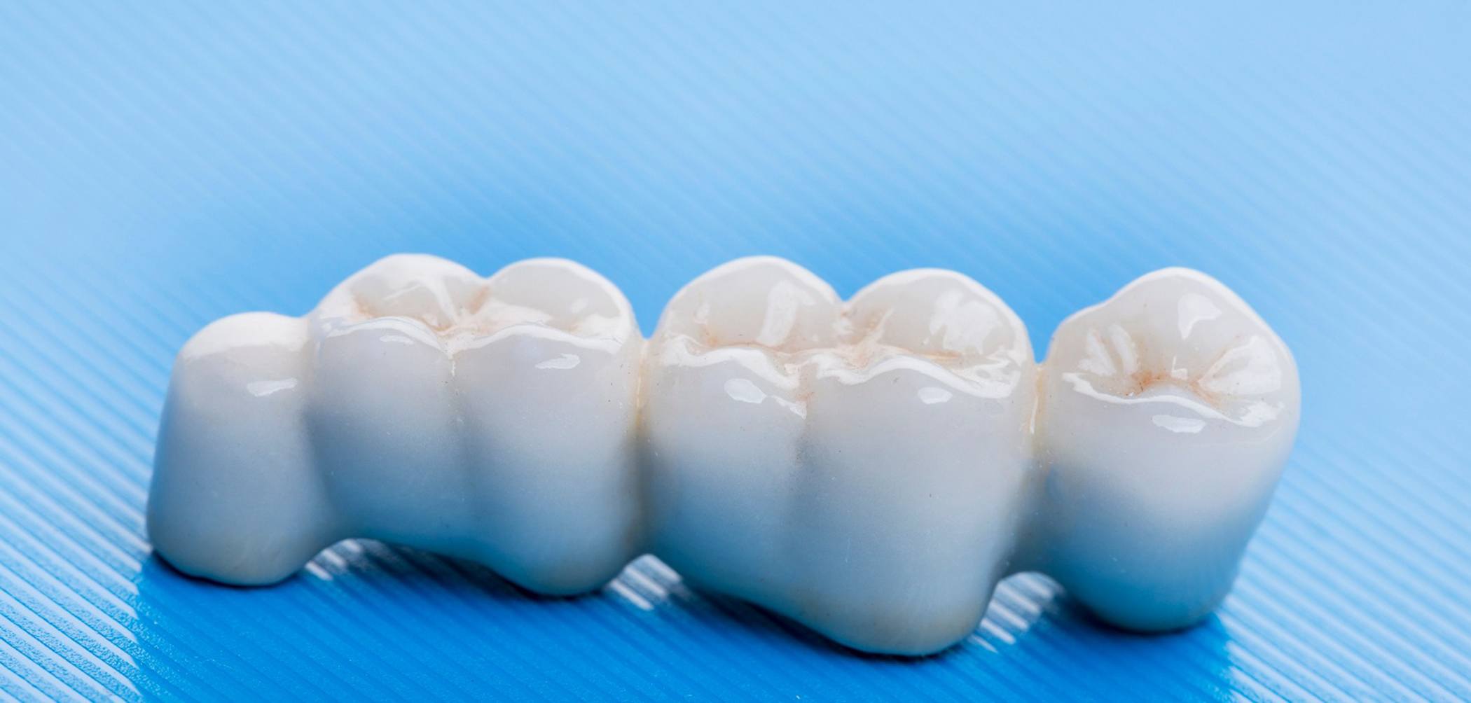 A traditional dental bridge