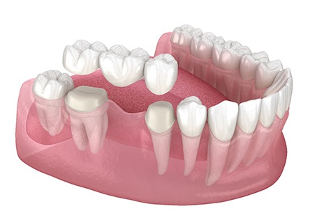 A CGI of a traditional dental bridge