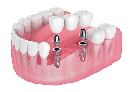 A CGI of an implant bridge
