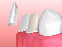 Animation of porcelain veneer placement