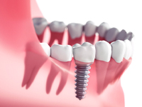 model of dental implant