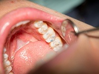 Closeup of teeth during tooth-colored filling placement