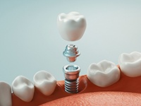 Crown, abutment, and dental implant in Midlothian, TX