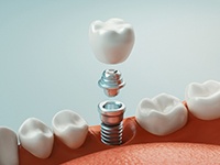 Model smile with implant retained dental crown