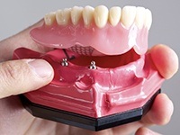 Model of implant supported denture