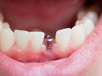 Close-up of a dental implant in Midlothian, TX before being restored