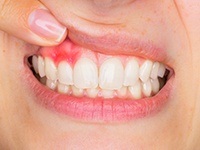 Red and inflamed gum tissue