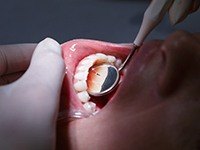 Closeup of smile during dental exam