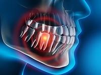 Animation of infectedtooth