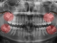 Dental x-ray with red highlighted wisdom teeth