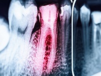 X-ray of damaged tooth highlighted red