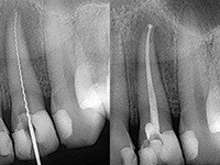 Dental x-rays of root canal treated teeth