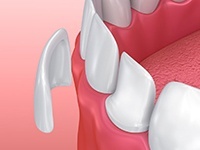 Animation of porcelain veneer placement