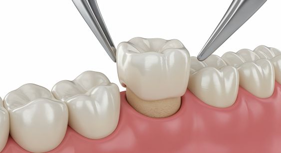 A computer-generated image of a crown being placed on a tooth.