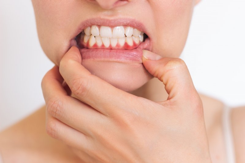 A closeup of a woman showing her inflamed gums