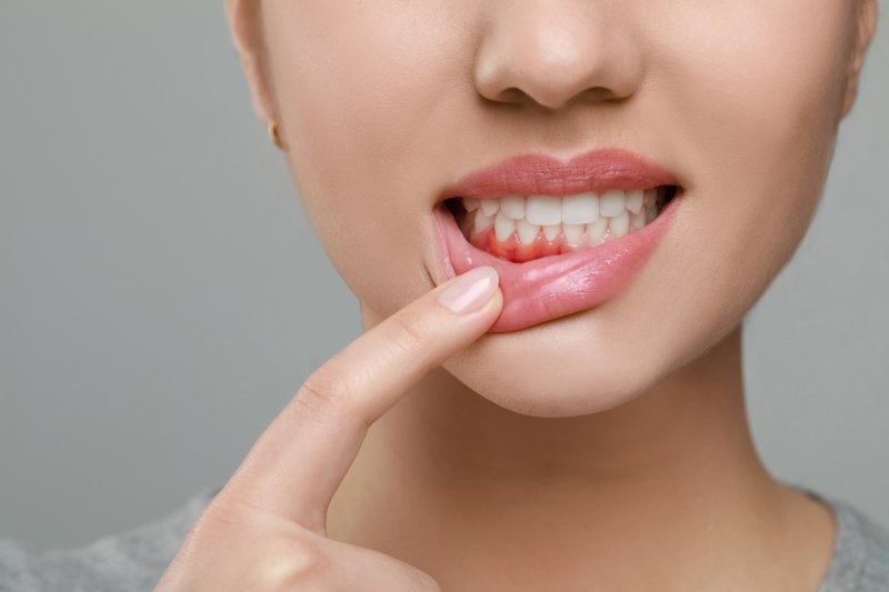 A woman revealing her smile’s gum disease