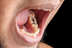Opening mouth to show metal filling on tooth in lower arch
